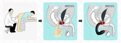 Массаж простаты: польза и вред - dr-nugmanov