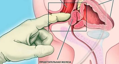 Как правильно делать массаж простаты мужу или самостоятельно в домашних  условиях