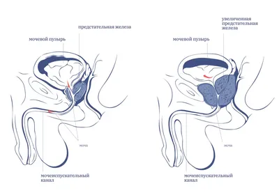 Так ли полезен массаж предстательной железы для мужского здоровья? Мнение  специалистов - ВСВІТІ