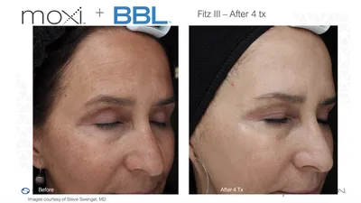 Moxi Laser: Pre And Post Treatment Instructions