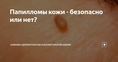 Папилломы кожи - безопасно или нет? | Клиника дерматологии и косметологии  Aderm | Дзен