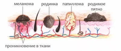 Как избавиться от Папилломавирусной инфекции (ВПЧ) на лице: причины,  симптомы, классификация, стадии, диагностика и лечение ВПЧ