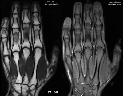 МРТ кисти руки в Новосибирске – цены в клинике «МРТ Альянс»