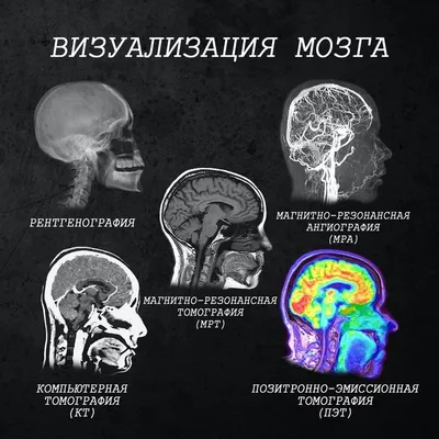 МРТ с зубными коронками или имплантами – можно ли делать?