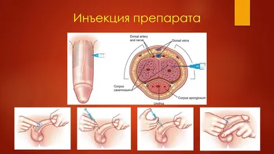 Рак полового члена: симптомы, признаки, диагностика, лечение