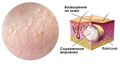 Как убрать брыли на лице и подтянуть обвисшие щеки: 7 эффективных способов