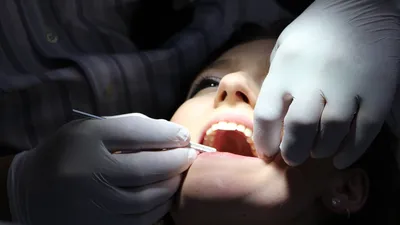 План зубов для дантиста с зубной щеткой,. Натюрморт на тему Odontology  стоматологии и стоматологии Стоковое Изображение - изображение  насчитывающей предмет, имплант: 173333713