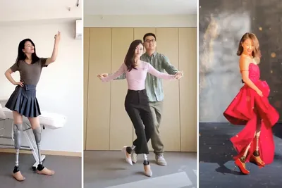Китаянка с протезами ног научилась танцевать на высоких каблуках
