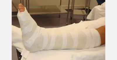 Гипс Пластиковый - «Сломали ногу или руку и теперь не мыться месяц? Гипс  нового поколения поможет вам вести привычный образ жизни с переломом.» |  отзывы