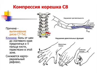 Грыжа диска C7