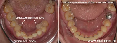 Номера зубов в стоматологии: расположение, фото, таблицы, схемы