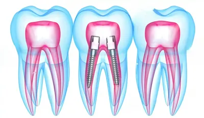 Гипердонтия — когда зубов во рту много