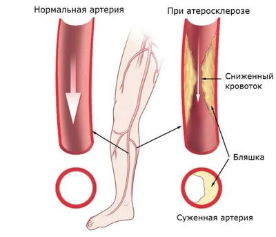 Облитерирующий эндартериит (ноги курильщика) - симптомы, лечение