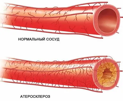 Облитерирующий эндартериит - лечение тромбангиита в Инновационном  сосудистом центре: заболевание сосудов нижних конечностей, симптомы и  причины (фото)