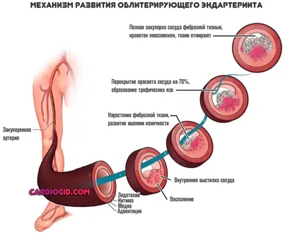 Лечение облитерирующего эндартериита - Октбярьский