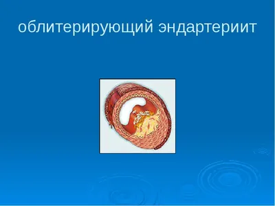 Атеросклероз нижних конечностей – облитерирующий и хронический - причина  онемения ног.