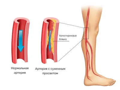 Облитерирующий эндартериит - лечение тромбангиита в Инновационном  сосудистом центре: заболевание сосудов нижних конечностей, симптомы и  причины (фото)