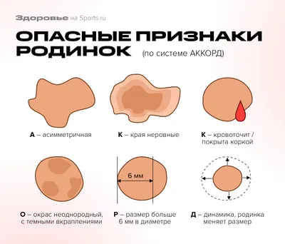 ОПАСНЫЕ РОДИНКИ: 6 признаков меланомы | Тело, Жизненные советы, Здоровье