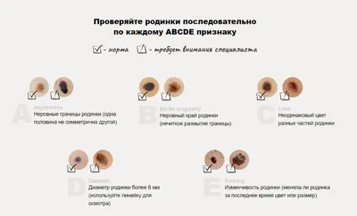 Опасные родинки: спасти вас может даже парикмахер