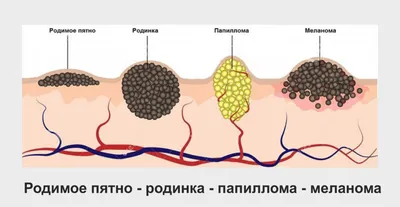 Опасные родинки: как определить и правильно ухаживать | РБК Стиль