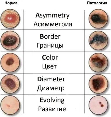 Опасные и безопасные родинки: признаки и диагностика