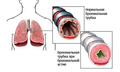 Заболевания органов дыхания - Медкор