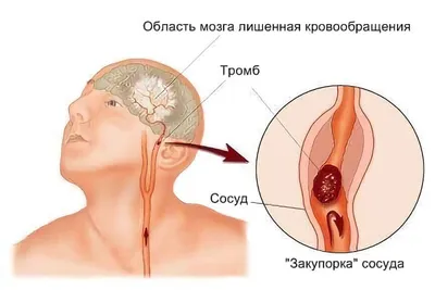 Головная боль: причины, диагностика, лечение - Клиника Лоритом