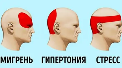 Головная боль напряжения: отличия, симптомы и эффективные способы лечения |  