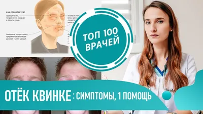 Ангионевротический отек Квинке / Интересный случай / Medicine Live