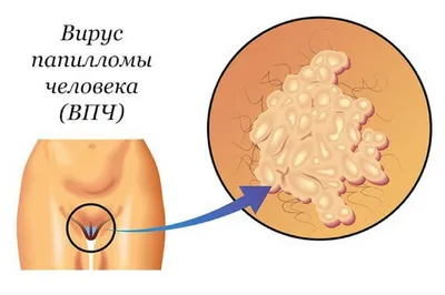 Что такое вирус папилломы человека? Подробная информация