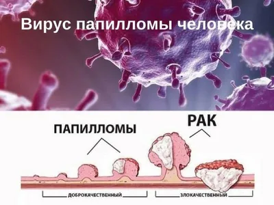 Как избавиться от Папилломавирусной инфекции (ВПЧ) на лице: причины,  симптомы, классификация, стадии, диагностика и лечение ВПЧ