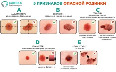 Рассеивание папиллом по коже – это опасно? - Полезные статьи Клиники Гуру