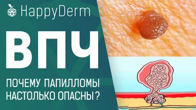 Почему важно своевременно удалять папилломы | OmniaClinic