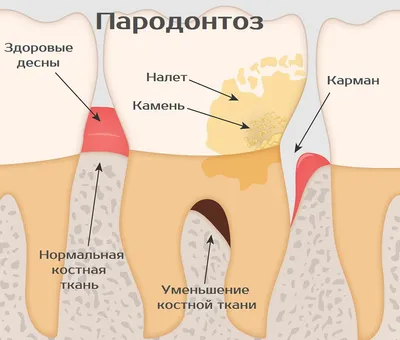 Пародонтоз - симптомы, причины, стадии и методы лечения | НАВА