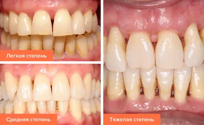 Пародонтоз и пародонтит. Различия, причины, меры профилактики и лечения