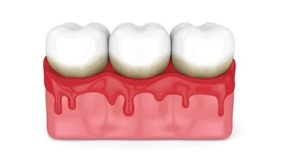 Как лечить пародонтоз: признаки, симптомы