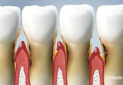 Протезирование зубов при пародонтозе и пародонтите в Минске - Новости и  статьи