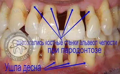 Современное лечение пародонтоза