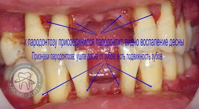 Пародонтоз картинки