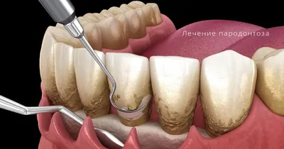Лечение десен в стоматологии пародонтоз пародонтит и гингивит