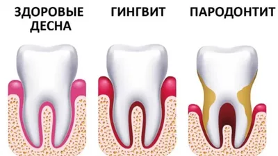 Лечение сложных форм пародонтоза и пародонтита в Санкт-Петербурге