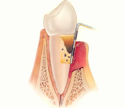 Лечение пародонтоза десен в Минске, цена