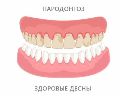 Что такое пародонтоз и как с ним справиться? (Ответы стоматолога) | OxiDen  | Стоматология Закревского 103