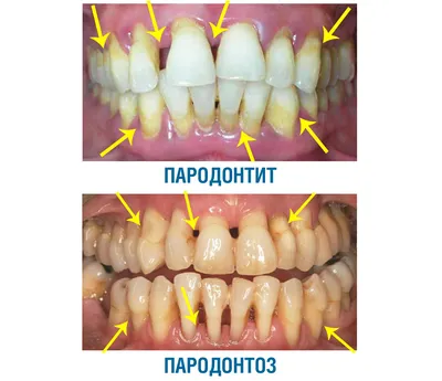 Пародонтоз 🚩 что это, причины, симптомы, чем лечить