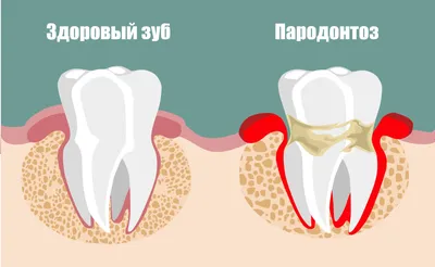 Пародонтоз – причины, симптомы, лечение в Москве – цены, отзывы в  стоматологических клиниках Зуб.ру