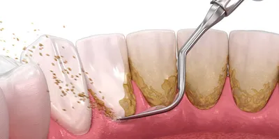 Пародонтоз виды и симптомы, лечение пародонтоза в Москве