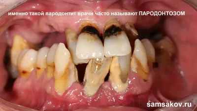 Пародонтоз десен и зубов: реабилитация после лечения - Альянс  бьюти-стоматологов, Москва