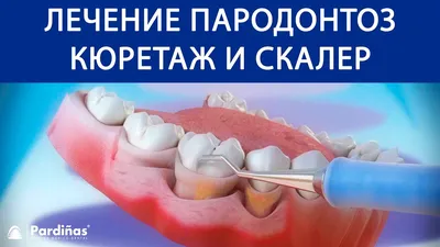 Варианты протезирования при пародонтите и пародонтозе | стоматологическая  клиника Кристалл