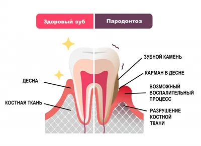 Как вылечить пародонтоз десен на разных стадиях