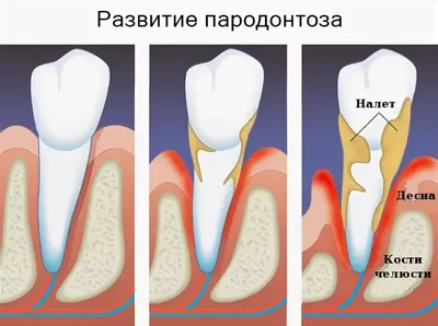 Пародонтоз I Частые симптомы, причины, лечение, профилактика